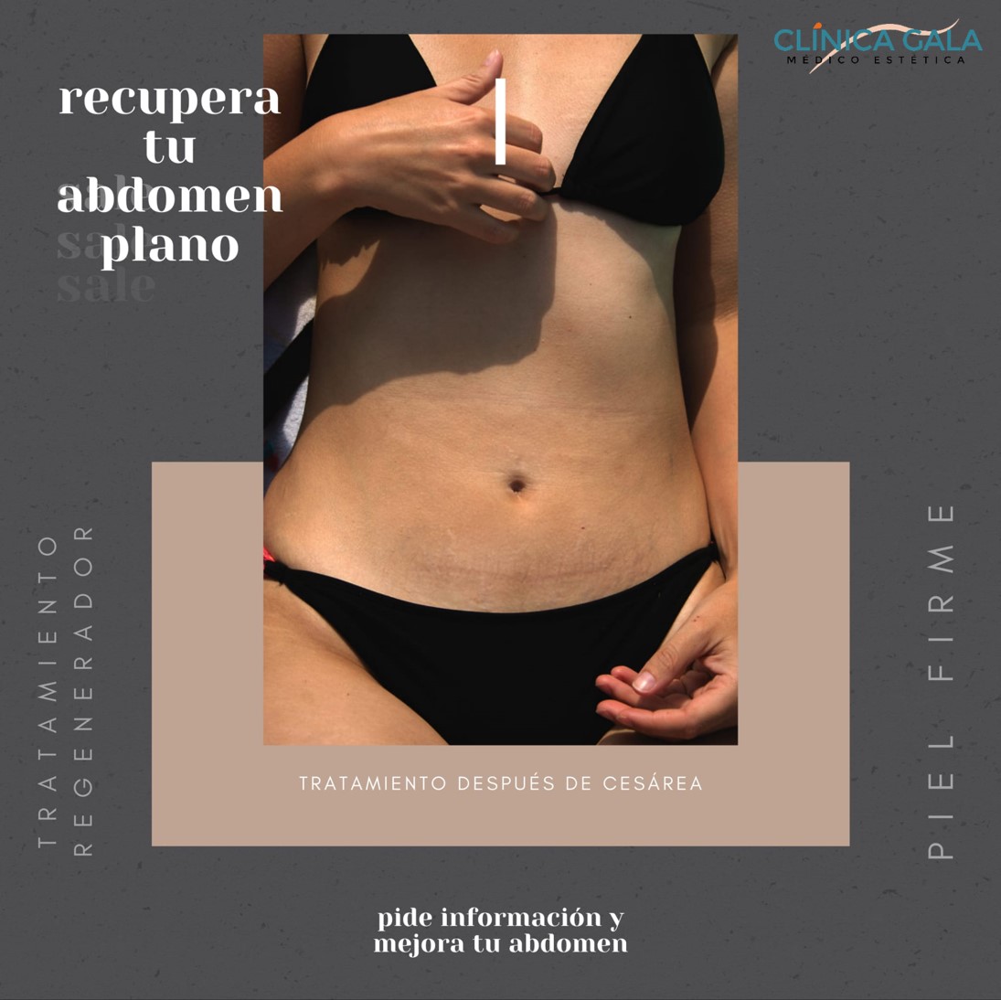 reducir abdomen archivos - Clínica Gala